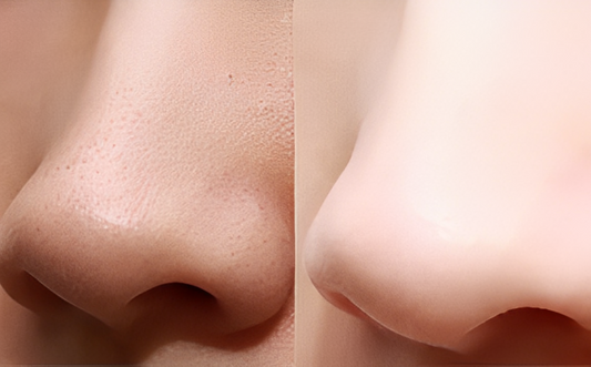 SkinsSonic Derma Ultrasonic Skin Scrubber – Blackhead Remover & Exfoliator